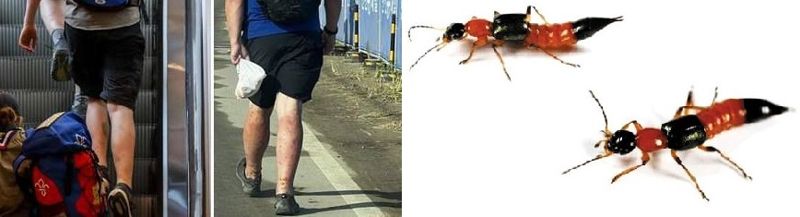 '새만금 세계스카우트잼버리'에서 벌레에 물린 참가자들의 다리(왼쪽) 화상벌레로 불리는 청딱지개미반날개'. 사진= 뉴시스, 연합뉴스, 국립생물자연관
