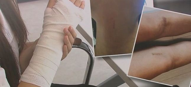 B군에게 폭행을 당한 A교사의 상처 모습. 출처=SBS 보도화면