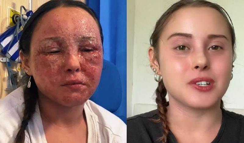 얼굴에 습진이 번진 베아트리체 가우카하우스의 모습(왼쪽) , 회복된 이후 모습 / 사진=beatrice gauca 틱톡