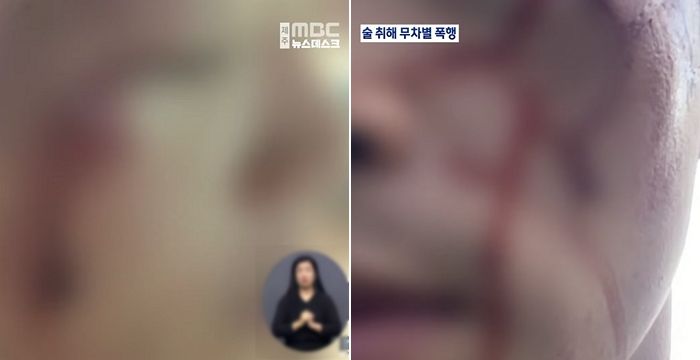 폭행으로 전치 6주 이상의 진단을 받은 B씨의 모습. 제주 MBC 보도화면