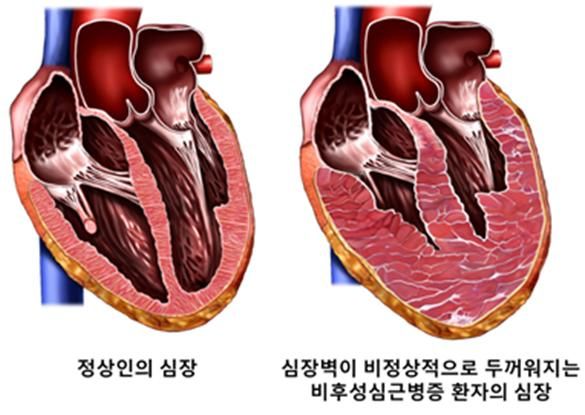 서울대병원, 비후성 심근증 환자 합병증 위험 예측 지표 제시