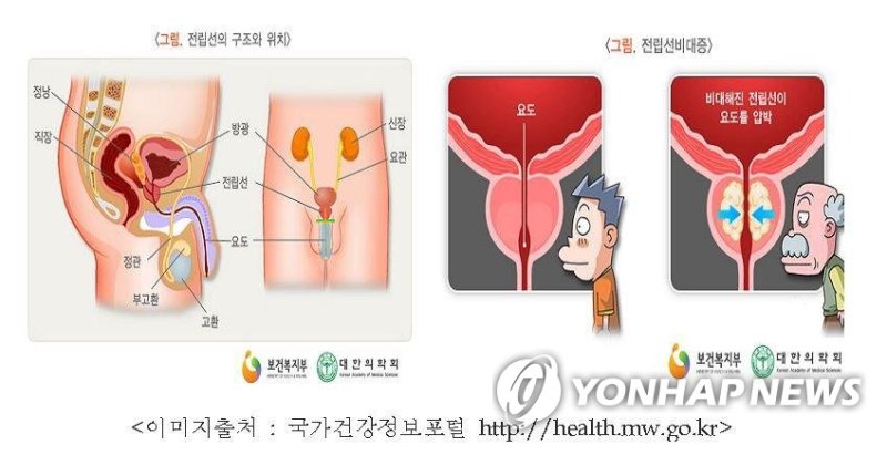 50대 남성의 '소변 전쟁'...전립선 치료법 총정리 [건강 처방전]