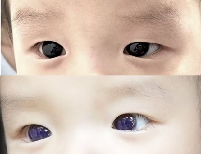 태국에서 6개월 된 남아가 코로나 치료로 항바이러스 약을 처방받은 후 눈이 파란색으로 변하는 이상 반응이 보고됐다. 위 사진의 눈이 정상, 아래 사진의 눈이 푸른색으로 변색된 상태. 출처=영국 데일리메일 캡처