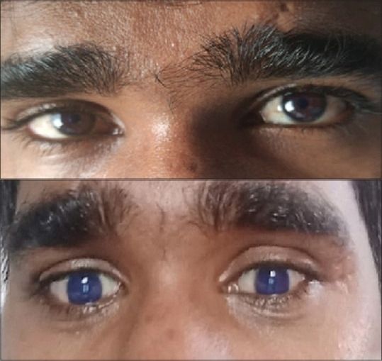 2021년 연구에서 인도의 20세 남성이 정확히 같은 눈 색깔 변화를 겪은 사례가 보고되기도 했다. 이 청년 역시 파비피라비르를 처방 받은 후 이튿날에 눈 색이 변했다. 위 사진이 정상 눈 , 아래 사진이 푸른색으로 변한 눈. 출처=영국 데일리메일 캡처]