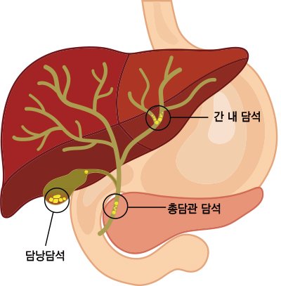 윗배 통증에 등까지 아프다면 '이것' 가능성