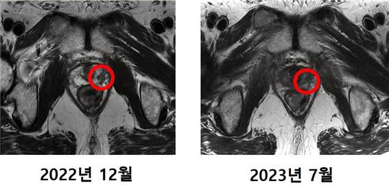 첫 중입자치료 환자 MRI 비교 사진. 세브란스 제공