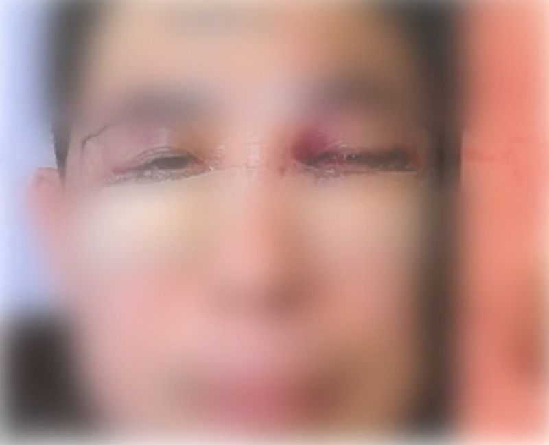 강남 성형외과서 눈밑지방재배치 수술 받은 50대, 하루만에 한쪽 눈 실명