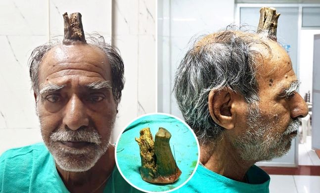 인도에서 74세 남성의 머리에 뿔이 생겼다. 사진=비샬 가즈비예 외과 전문의 제공