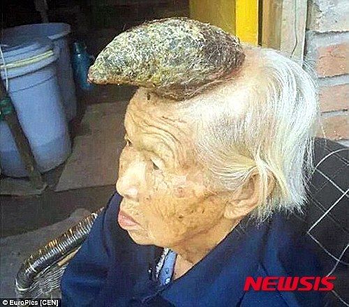 중국 쓰촨(四川)성에 사는 리앙 쓰젠(87)이라는 할머니의 머리에 13㎝에 이르는 뿔이 생겼다. 의료진은 이것을 피부질환의 일종인 '피각'이라고 진단했다. 뉴시스