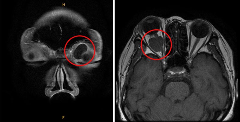 좌측 안와 앞쪽에 생긴 낭성 종괴(왼쪽), 우측 안와 뒤쪽에 생긴 시신경종양(오른쪽). 순천향대 부천병원 제공