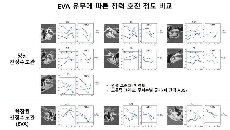 확장된 전정수도관(EVA) 유무에 따른 중이 수술 후 air-bone gap(ABG)을 통해 살펴본 청력 호전 정도에 대한 비교. 서울대병원 제공