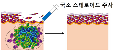 사망률 80% ‘천포창’ 만성 물집, 치료방법 나왔다