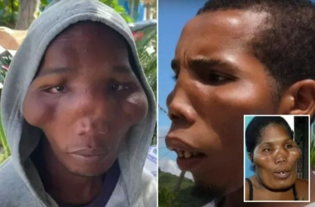 '사자 얼굴 증후군'으로 알려진 레온티아증을 앓고 있는 도미니카공화국 남매의 얼굴. [더선]