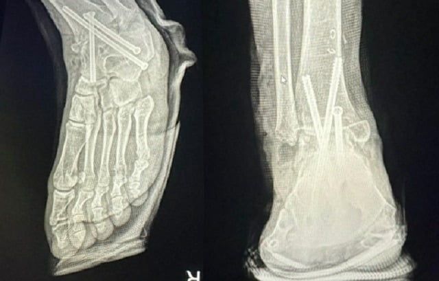 병원 실수로 멀쩡한 발목뼈를 절단해 철심 3개를 박은 모습. 복숭아뼈를 절단해 아래의 뼈들과 고정했다. 이 때문에 발목을 구부리거나 펴기가 어려워 정상적으로 걷지 못하게 됐다. 사진 연합뉴스, 제보자 제공