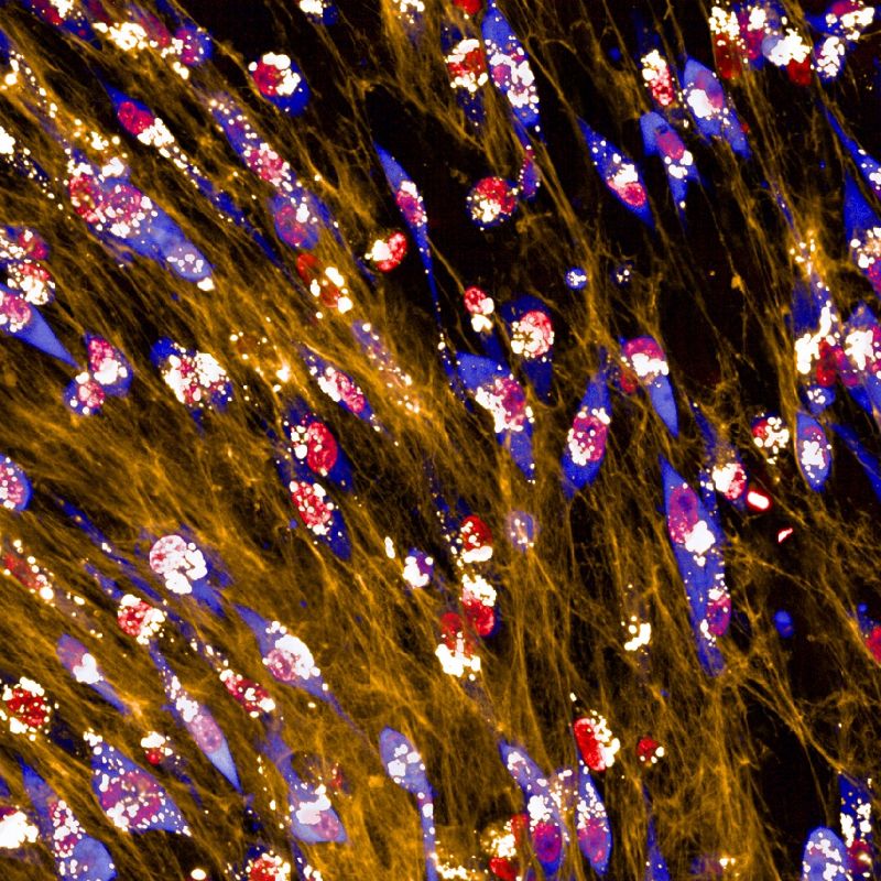 유방암 세포(파란색)가 세포외 기질(노란색)을 먹고 있습니다. 세포 내부의 밝은 흰색 반점은 세포가 성장을 지원하는 영양분을 얻기 위해 소화되는 세포외 기질 성분입니다. 몬세라트 란세스 마르티네스 제공