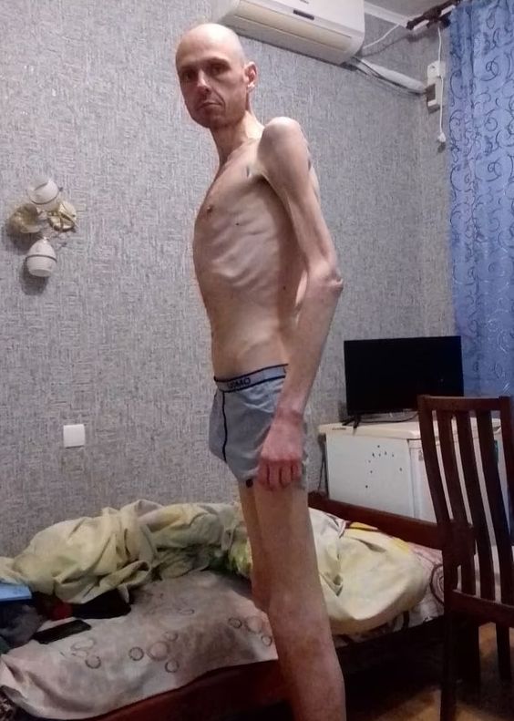 러시아군서 포로 생활 결과... 충격적 몸 상태 사진 공개
