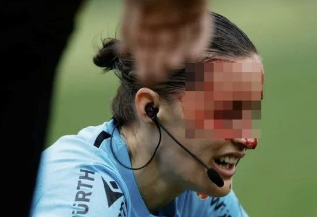 스페인 프로축구에서 여성 심판이 카메라에 얼굴을 맞아 크게 다치는 사고가 발생했다. /사진=토크스포츠,매일경제
