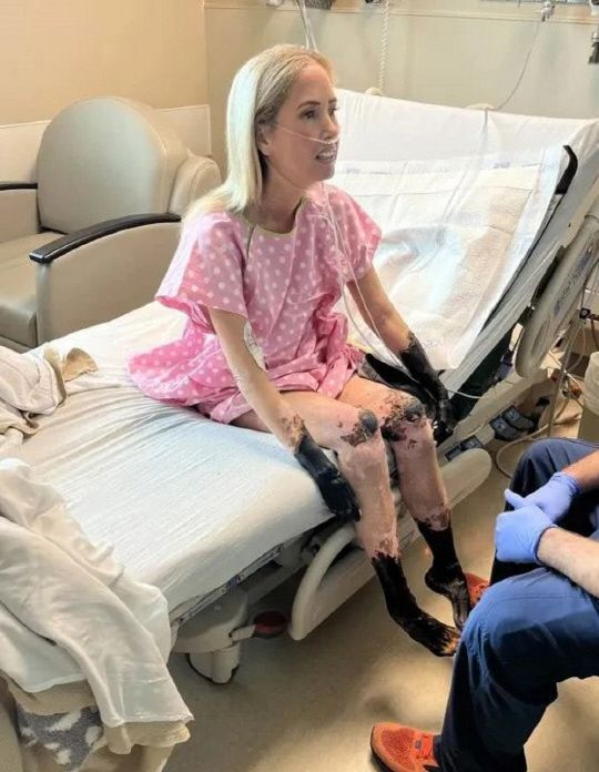 미국의 50대 여성 셰리 무디가 패혈증을 앓고 팔과 다리를 결국 절단했다.(사진=NP)