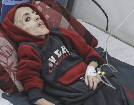 영양실조로 사망한 가자지구 10살 소년 야잔 카파르네 / 엑스 갈무리