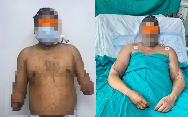 인도에서 비극적인 기차 사고로 두 팔을 잃은 남성이 팔을 이식 받는 데 성공했다. 사진=뉴욕포스트 캡처