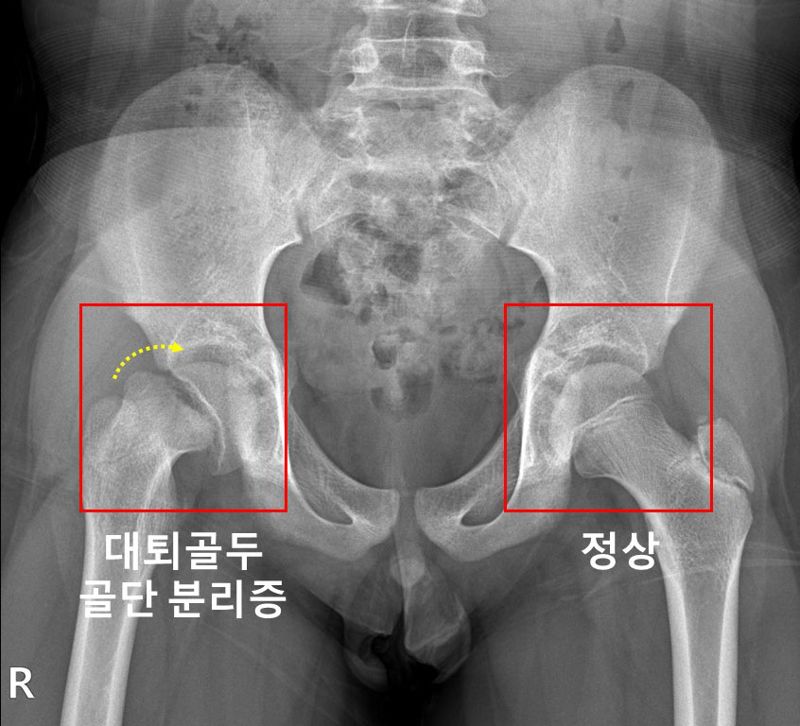 우측 고관절에 대퇴골두 골단 분리증이 발생한 소아청소년 환자의 X-레이 사진. 서울대병원 제공