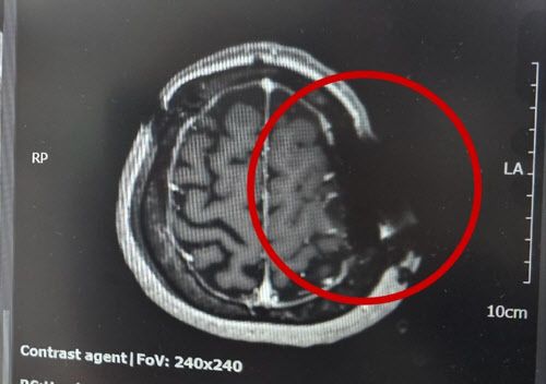 톱날이 박힌 채 봉합해 MRI 검사에서 뇌 일부가 촬영되지 않은 모습. 연합뉴스