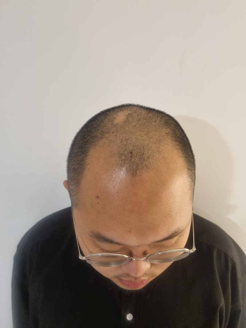 [서울=뉴시스] 권신혁 수습기자 = 탈모인 이민근(27)씨는 탈모가 진행되자 머리를 밀었다. 사진은 머리를 민 이씨의 모습이다. 2024.04.30. innovation@newsis.com