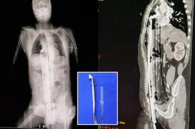 사고 당시 찍은 남성의 엑스레이. 중앙에는 남성의 몸을 관통한 쇠막대기가 보인다. 출처=더 선 홈페이지 캡처