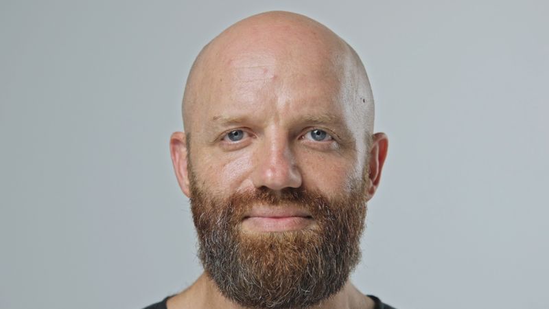 대머리 남성이지만 수염은 많이 자라있다. 모제림성형외과 제공