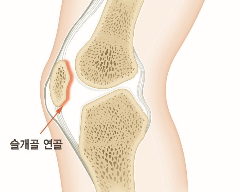 무릎에서 '뚝'..무릎연골연화증 2030세대 발생 높아 [weekend 헬스]