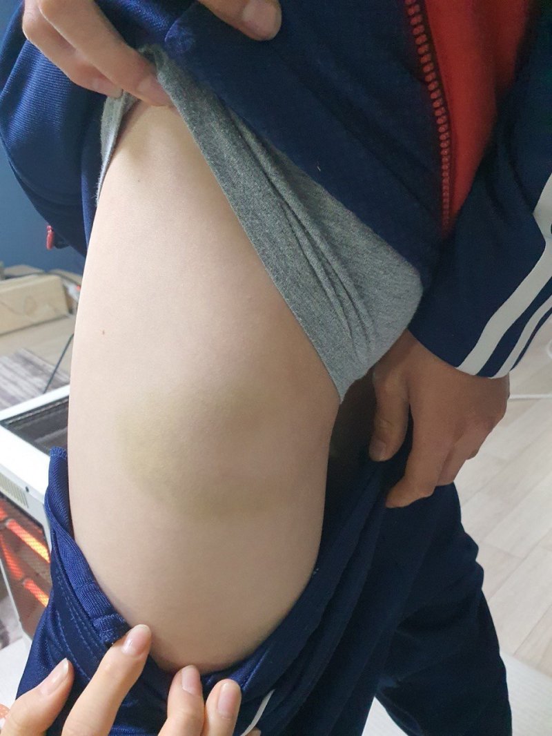 피해 아동 측에서 사건 발생 후 촬영한 멍자국.(피해 아동 측 제공)/뉴스1