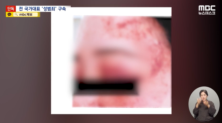 전 럭비 국가대표 선수이자 옛 연인인 A씨에게 폭행을 당한 B씨/ 사진=MBC뉴스데스크 캡처