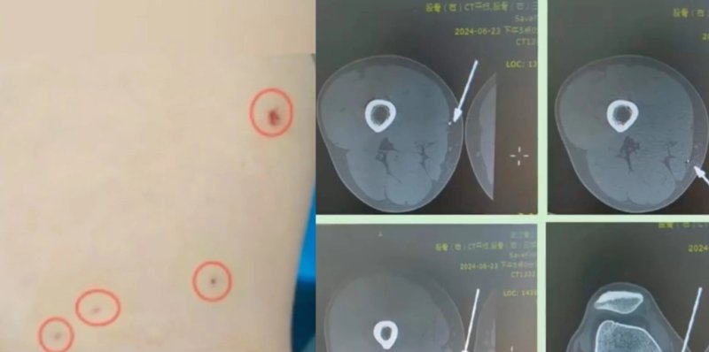 중국의 한 남성이 마블 영화의 대표적인 캐릭터 '아이언맨'을 따라하려다 병원으로 이송돼 응급 처치를 받았다는 사연이 전해졌다.<div id='ad_body3' class='mbad_bottom' ></div> /사진=weibo, 뉴시스