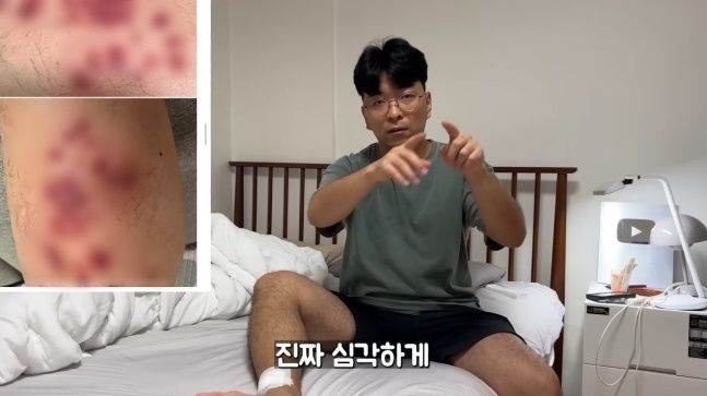 “동남아서 7000원 발 마사지 받고 염증...수술로 전부 긁어내”