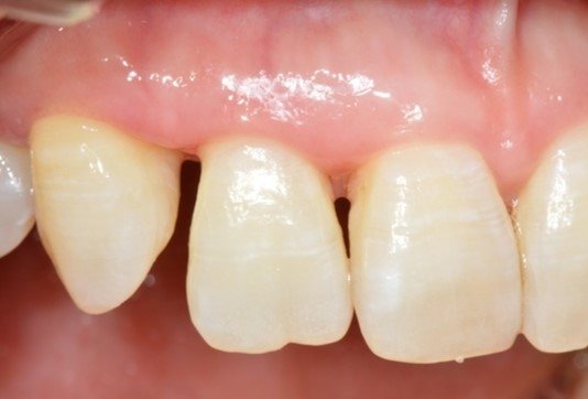 [위클리 건강] "이쑤시개 잦은 사용보단 치실·치간칫솔 쓰세요" 이쑤시개를 자주 써 치아가 벌어진 환자의 모습 [서울대치과병원 제공]