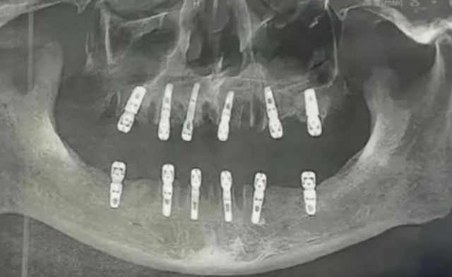 중국에서 하루에 23개의 치아를 뽑고 임플란트 12개를 이식한 남성이 13일 후 심장마비로 사망했다. /사진=상하이데일리,헤럴드경제