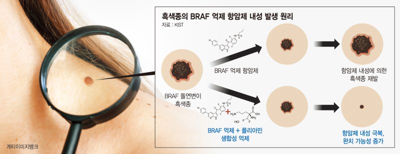 항암제 안 통하는 흑색종, 원인 찾았다… 신약 개발 기대