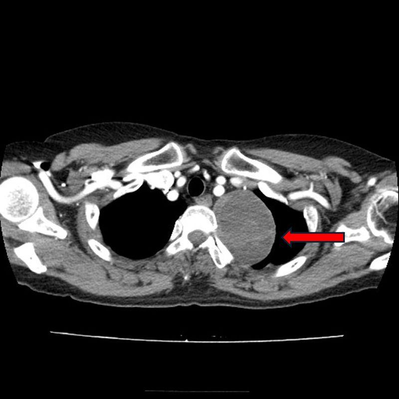 종격동 종양 환자의 흉부 CT사진. 고대 안산병원 제공
