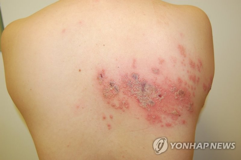 대상포진 환자 연간 70만명…10대 미만 5년간 14% 늘어