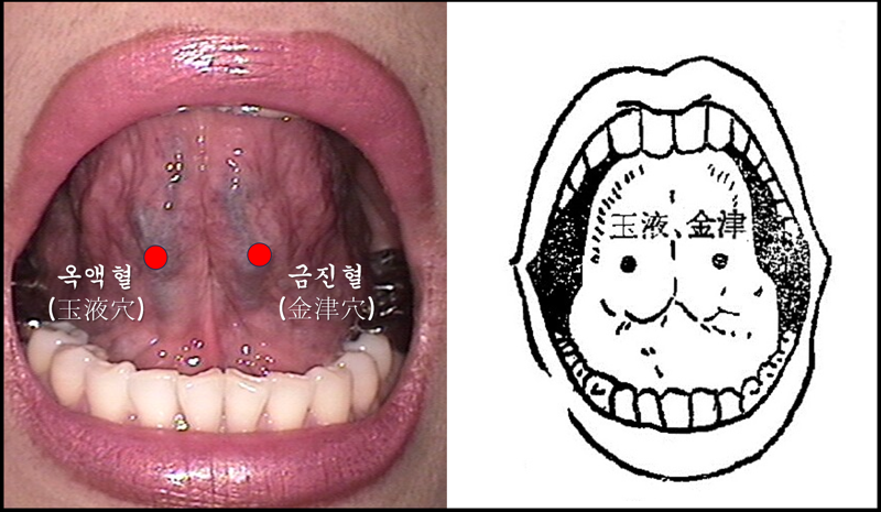 [한동하의 본초여담] 설하침 사혈요법은 OOOO을 찌르는 것이다