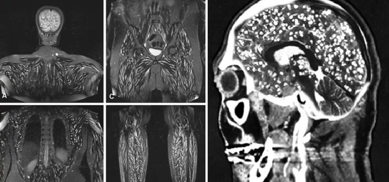 살 빼려고 '기생충알' 삼킨 20대 여성, MRI 검사 해봤더니... 충격