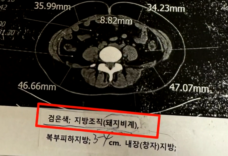 A씨 측이 받은 CT 검사 결과지/사진=JTBC '사건반장' 캡처