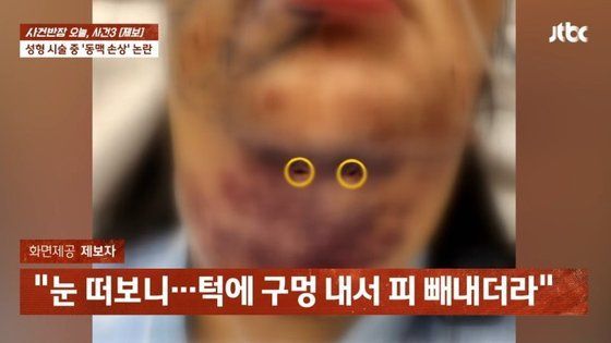 강남 성형외과서 턱 뚫렸다..의사 "죽지는 않을 것" 무슨 일이?