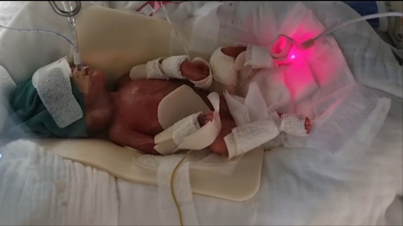 [서울=뉴시스]512g의 초극소미숙아로 태어난 예찬이가 약 5개월 만에 3.68kg로 건강하게 가족의 품으로 돌아갔다. 초기 입원사진. (사진=서울성모병원 제공) 2024.10.30. photo@newsis.com.