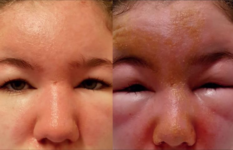"눈 퉁퉁 붓고, 수포 생겨"..여드름 연고 바를 때 '이 성분' 꼭 확인해야 [헬스톡]