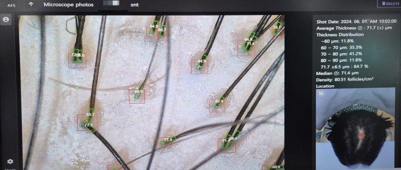 아프스(AFS)의 AI 기반 정밀 탈모 진단 장치 'AFS 3D'로 촬영한 모발 분석 화면.2025.1.8/뉴스1 최동현 기자