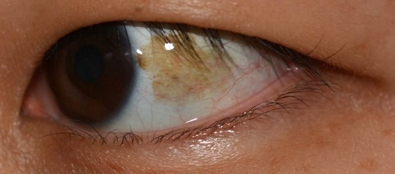 "어디 아프니?" 미관상 좋지 않은 "노랗게 변한 흰자위" 방법은