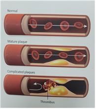 동맥경화증 진행 단계. 맨 위쪽 사진은 정상 혈관 모습. 두 번째는 혈관 내 지방 성분이 침착돼 혈관이 좁아지는 모습. 세 번째는 혈관 내벽이 더 좁아지고 파열돼 피떡(혈전) 등이 발생한 모습.