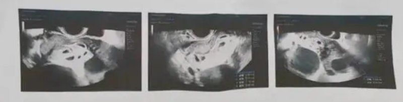 아홉 쌍둥이 임신했던 25세 中 여성, 안타까운 근황