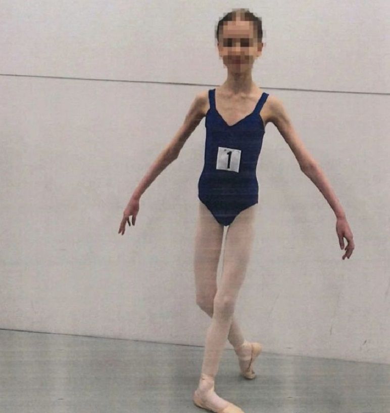 17살 소녀 몸무게가 고작 27㎏…8살때부터 채식시킨 부모 [헬스톡]